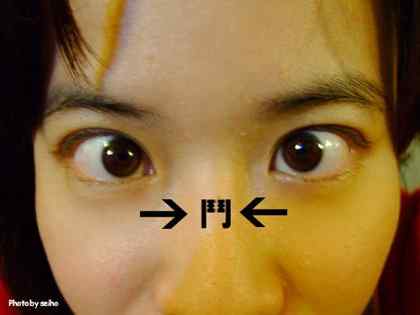 斗鸡眼